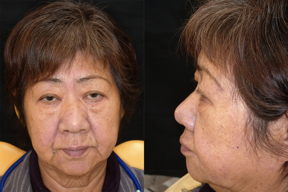 he initial situation with the facial features of the patient without dentures.