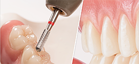 Die Abrasionsbeständigkeit von VITA MRP-Material am Beispiel von VITA PHYSIODENS® Die Abrasionsbeständigkeit von VITA MRP-Material am Beispiel von VITA PHYSIODENS®