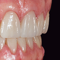 Fachartikel. Monolithische, zeiteffiziente Frontzahnversorgung