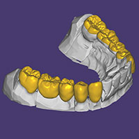 Prothetische Verbundl&ouml;sung f&uuml;r hohe Kaukraftbelastung