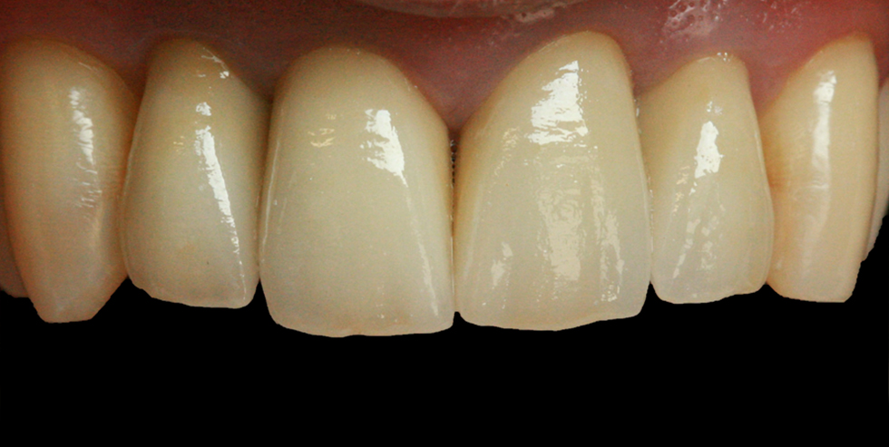 VITA patient case Urszula Młynarska. The crowns directly following cementation.