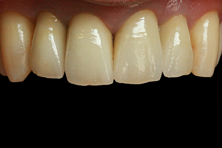 Step 10 The crowns directly following cementation