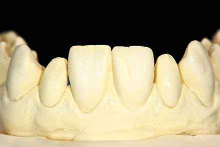 Zapfenzähnen mit Non-Prep-Veneers