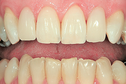 The result of the non-prep veneers
