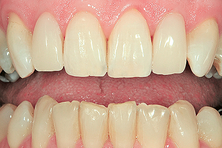 Das Ergebnis der Non-Prep Veneers