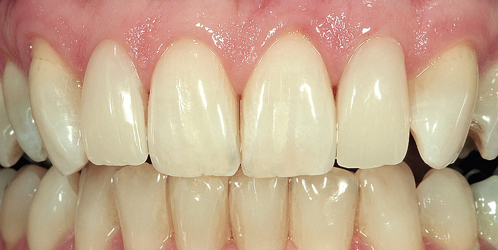 Patient case. Veneers in harmony with other teeth. With VITA SUPRINITY