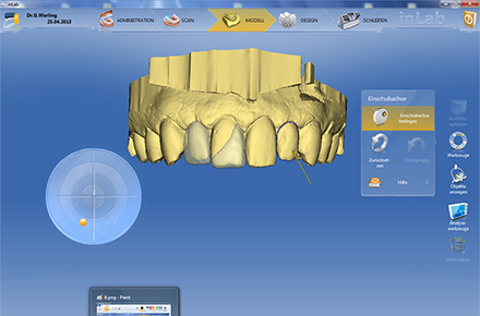 Step 3 constructed non-prep-veneers