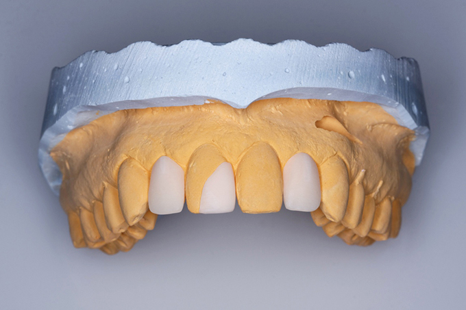 Fitting directly after milling using Sirona inLab MC XL.
