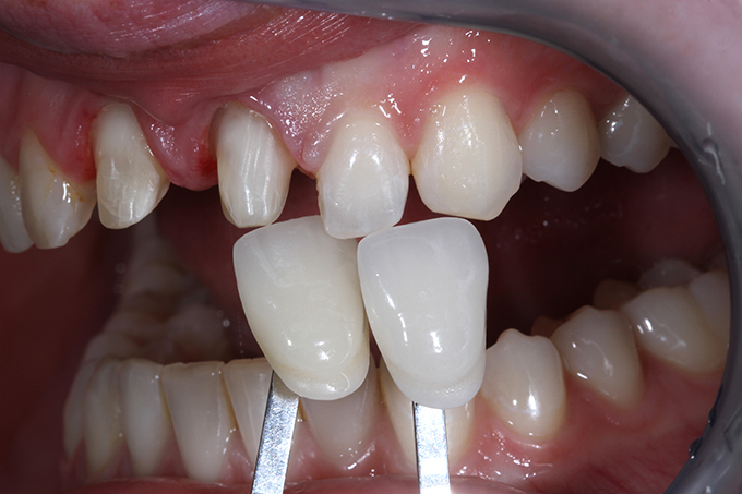 Visual comparison of the shade and the clinical situation after preparation.