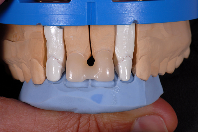 Blocked zirconium dioxide crowns