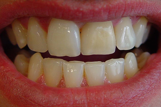 Step 1 Abweichende Zahnfarbe