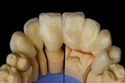 Palatal view of the anterior bridge