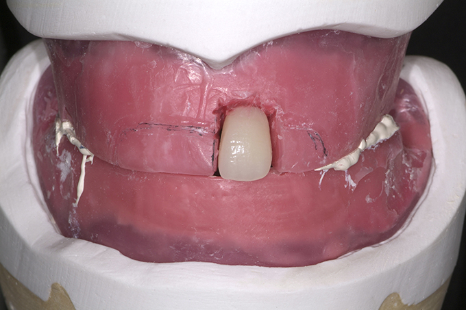 Step 3 Die für den Zahn erforderliche Wachsmenge wird aus dem Wall entfernt und durch den Zahn 21 ersetzt.