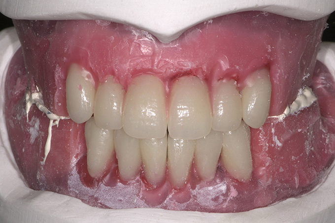 Aufstellung der Zähne 32 und 42 in die entstandene Lücke.