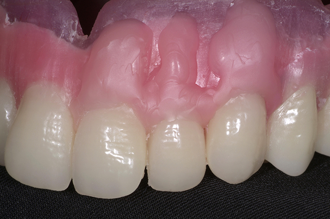 Step 8 Modellation des Alveolarfortsätze und der Zahnfleischkonturen