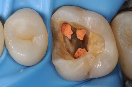 Tooth with new RCT in place