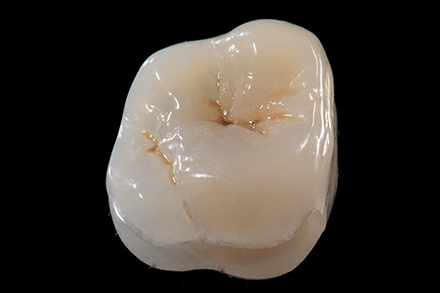 Occlusal anatomy