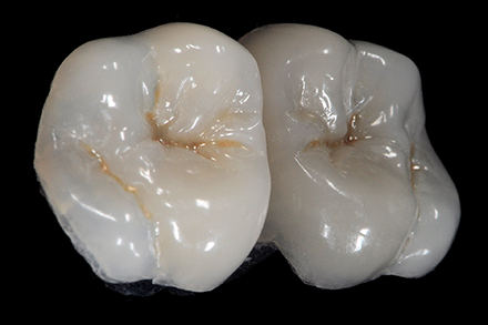 Occlusal anatomy