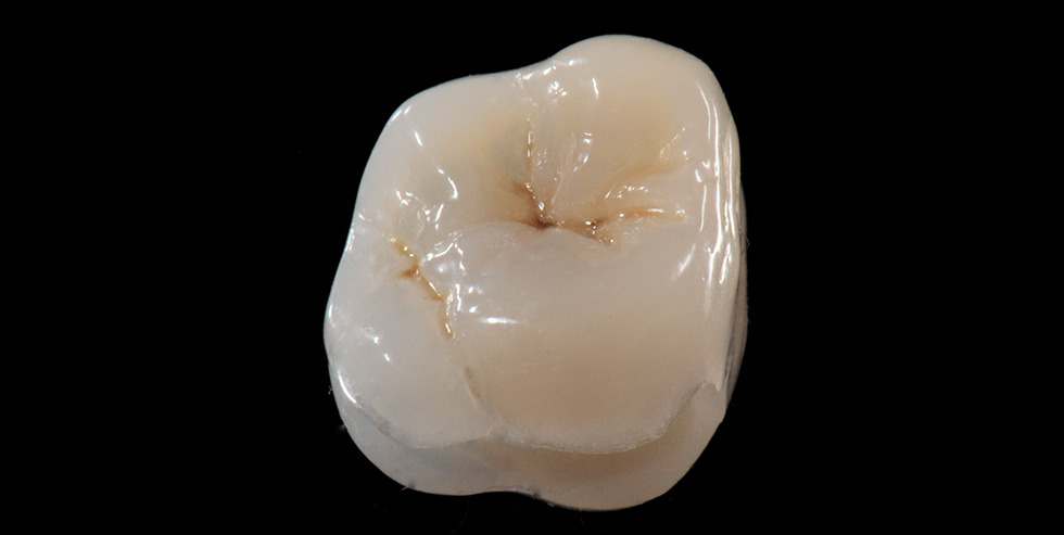 Inlay auf Zahn 26, hergestellt aus VITA VM LC
