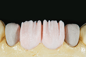 Caso clínico Marcio Breda: Primera capa de dentina