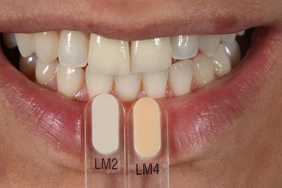 Patient case Marcio Breda: Tooth Shade Determination