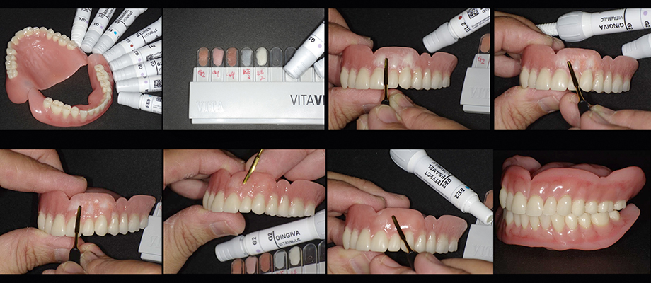 Patient case of Dr. Fumiaki Yamazaki and Toru Odagaki, Japan.