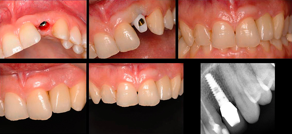 VITA Around The World. Halit Yağcı. Bursa, Türkei. Fall 6: Implantat