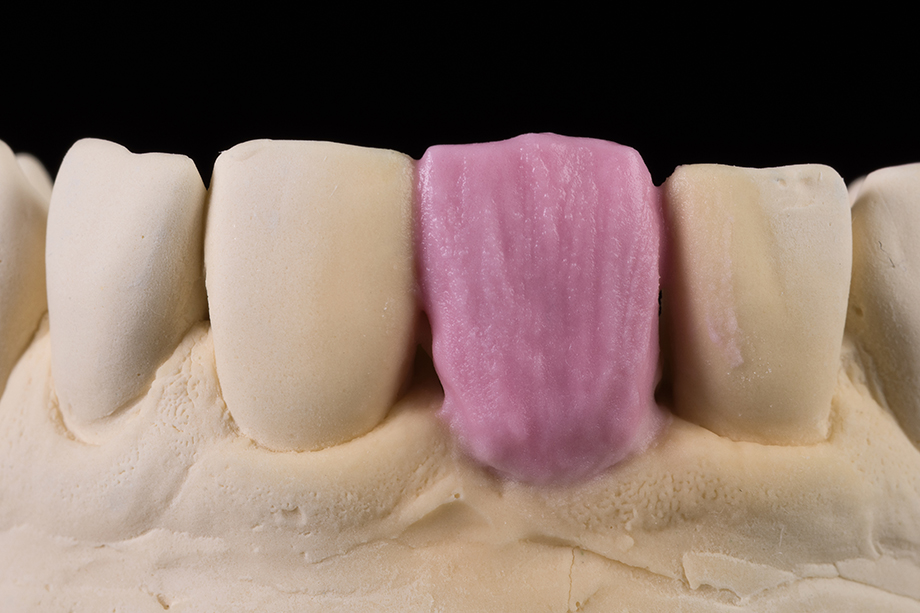 Schichtung des Dentinkerns Schichtung des Dentinkerns