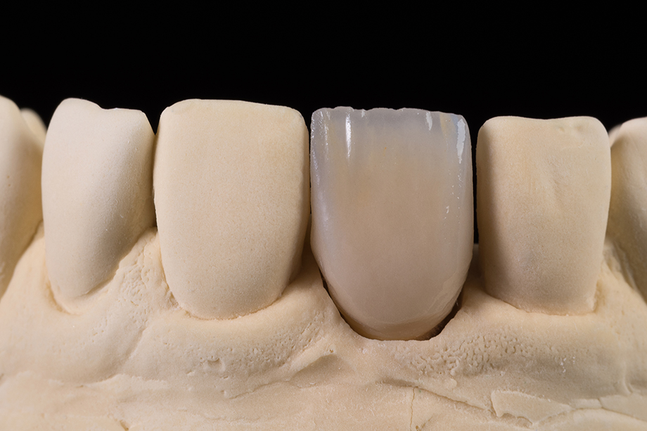 Ergebnis nach dem 1. Dentinbrand Ergebnis nach dem 1. Dentinbrand