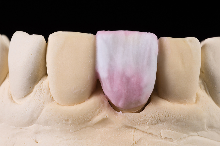 Schichtung von vestibulär Schichtung von vestibulär