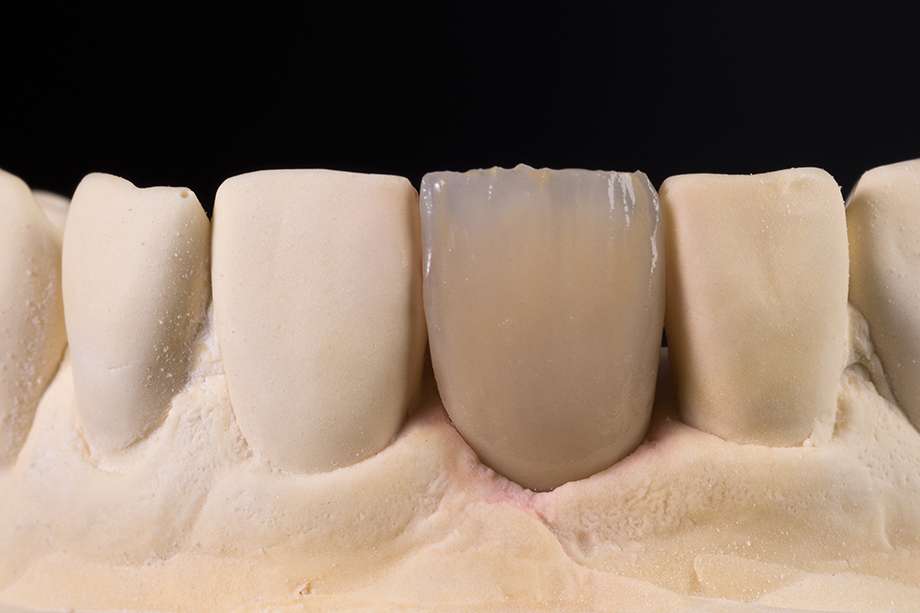 Ergebnis nach dem 1. Dentinbrand Ergebnis nach dem 1. Dentinbrand