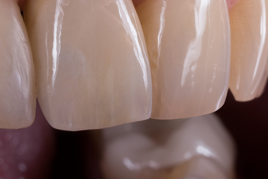Detailed lateral view of the maxillary incisors Detailed lateral view of the maxillary incisors