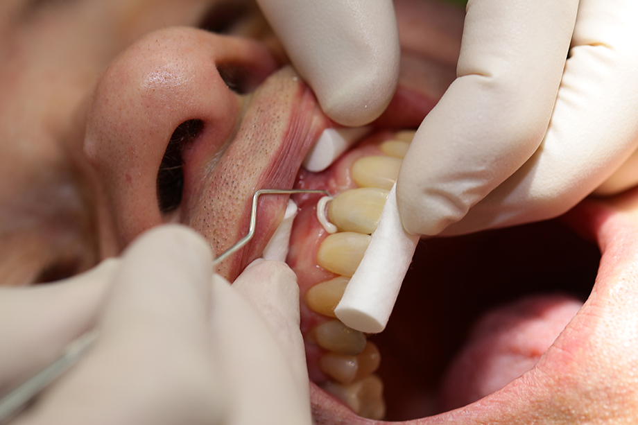 Removal of the excess vestibular cement Removal of the excess vestibular cement