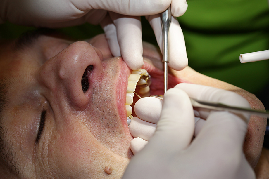 … and the excess palatal cement … and the excess palatal cement