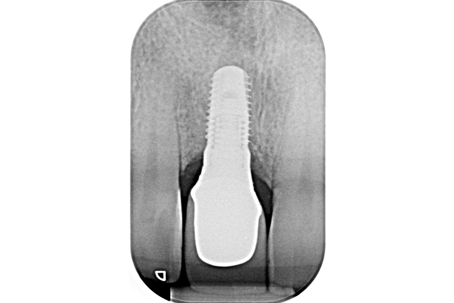 Control x-ray after cementing Control x-ray after cementing