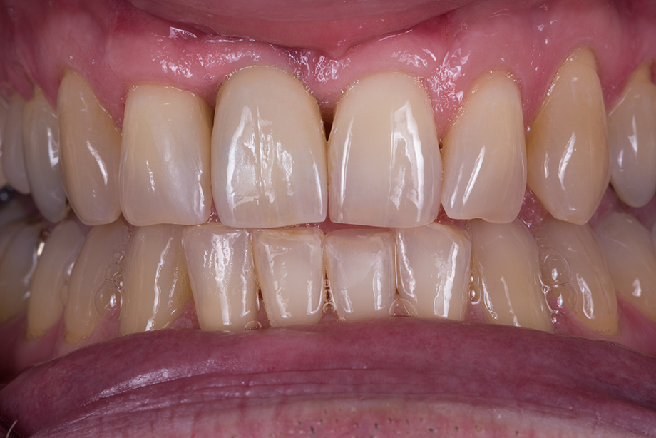 The final aesthetic result in protrusion The final aesthetic result in protrusion