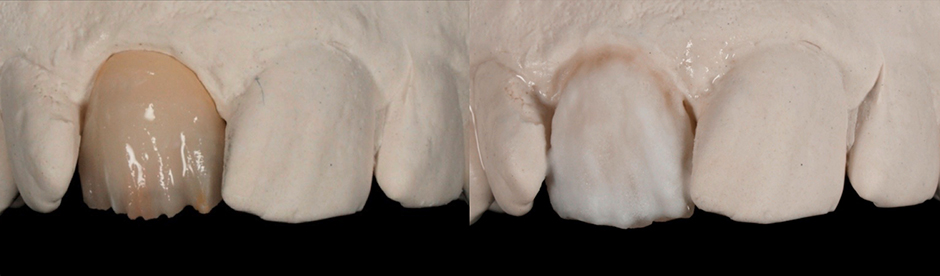 Incisal edge