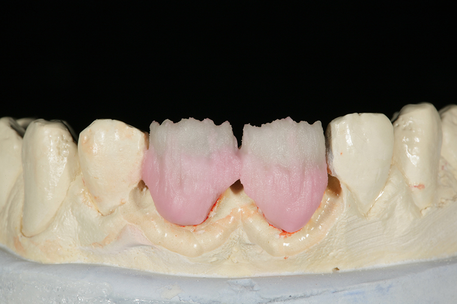 Клинический случай из практики Амоса Хартинга, США. Реставрация фронтальных зубов. Нанесение VITA VM 9 BASE DENTIN.