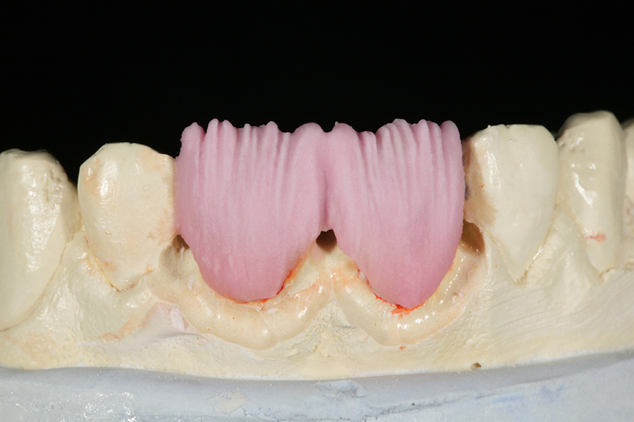 Caso clinico di Amos Harting, USA. VITA VM 9 BASE DENTINE.