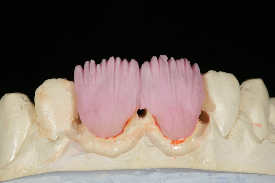 Cas clinique d'Amos Harting, USA. TRANSPA DENTINE