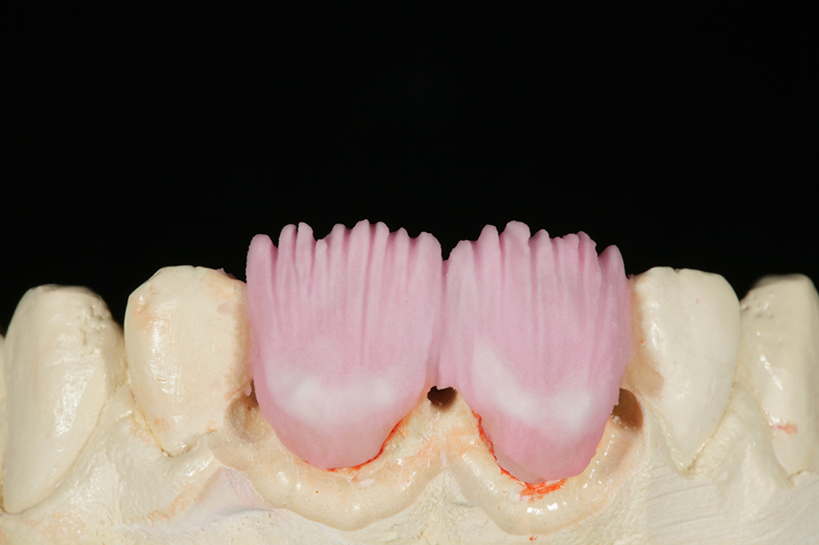 Patient case from Amos Harting, USA. EFFECT CHROMA