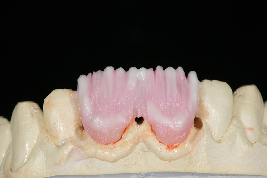 Клинический случай из практики Амоса Хартинга, США. Реставрация фронтальных зубов.