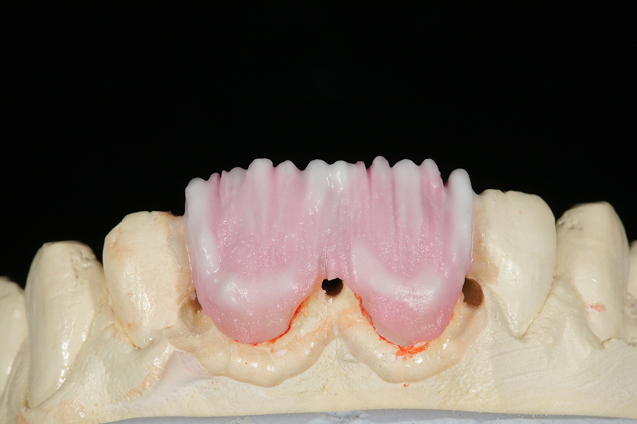 Caso clínico de Amos Harting EE.UU. EFFECT ENAMEL.