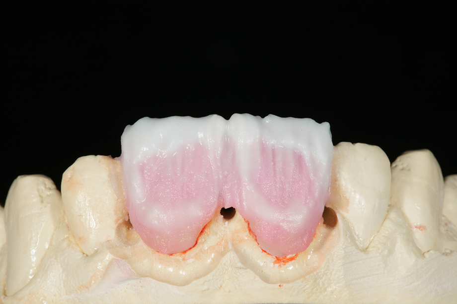 Клинический случай из практики Амоса Хартинга, США. Реставрация фронтальных зубов.
 EFFECT ENAMEL.