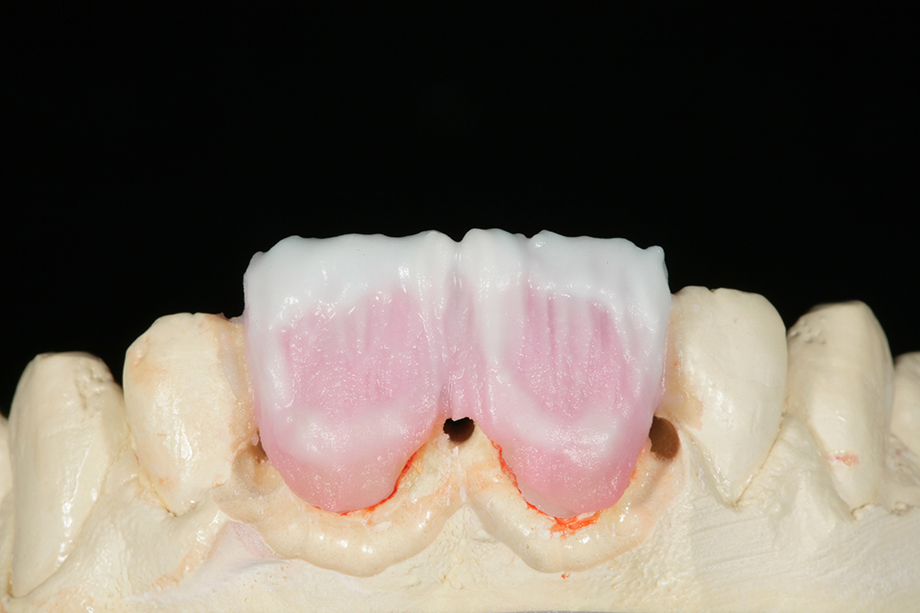 Caso clínico de Amos Harting EE.UU. EFFECT ENAMEL.