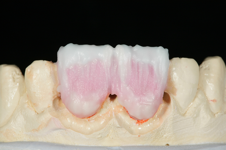 Caso clínico de Amos Harting EE.UU. EFFECT ENAMEL.