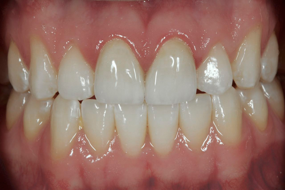 Клинический случай из практики Амоса Хартинга, США. Реставрация фронтальных зубов.
Ситуация До / После.