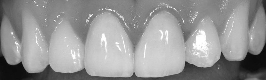 Клинический случай из практики Амоса Хартинга, США. Реставрация фронтальных зубов.
Конечный результат во рту.