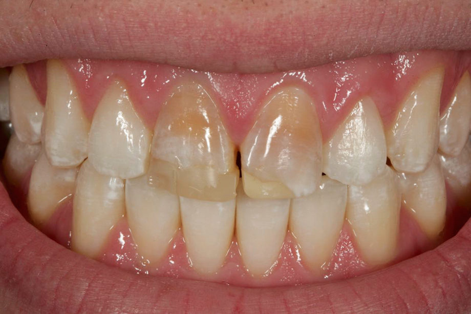 Patient case from Amos Harting, USA. Initial situation: patient, 19 years old, with traumatized incisors.