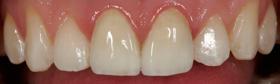 Patient case from Amos Harting, USA. Final result in mouth.